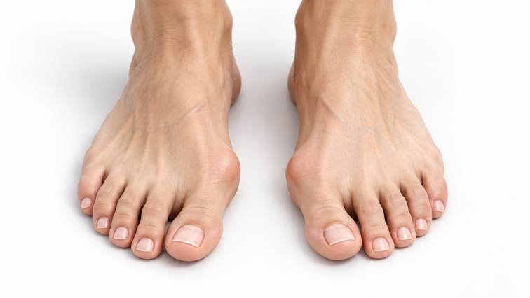 Paluch koślawy (hallux valgus)